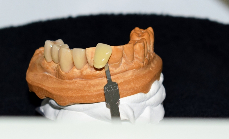 Odontotecnici: un mancato riconoscimento che sa di beffa